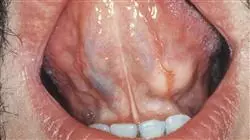 posgrado tumores benignos cavidad oral Tech Universidad
