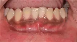 estudiar lesiones blancas premalignas cavidad oral Tech Universidad