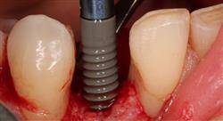 especializacion implantología oral