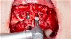 experto implantologia oral