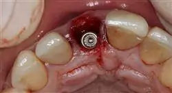 especialización implantología oral