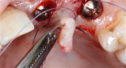 experto universitario periodoncia aplicada a la implantología