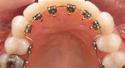 curso ortodoncia lingual