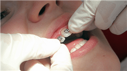 diplomado acreditado ortodoncia lingual