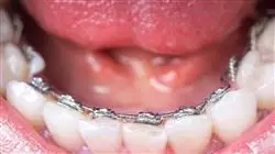 diplomado online ortodoncia lingual