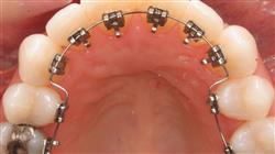 diplomado ortodoncia lingual
