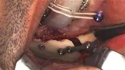 diplomado acreditado ortodoncia y cirugía ortognática