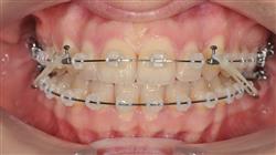 formacion ortopedia dentofacial temprana