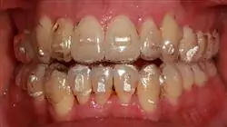 curso acreditado ortodoncia termoplástica