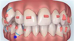 estudiar ortodoncia termoplástica