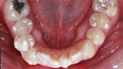 ortodoncia termoplasti