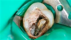 maestria endodoncia microcirugia apical