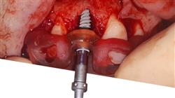master implantologia cirugia oral