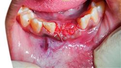 posgrado implantologia cirugia oral