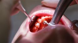 master periodoncia cirugia mucogingival