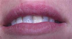 especializacion online tratamientos odontológicos del sector anterior mínimamente invasivos