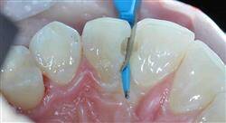 experto universitario tratamientos odontológicos del sector anterior mínimamente invasivos
