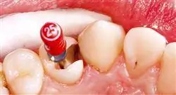 cursos retratamiento del diente endodonciado