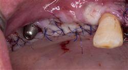 especializacion online retratamiento del diente endodonciado