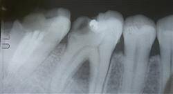 especializacion retratamiento del diente endodonciado