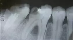 especializacion retratamiento del diente endodonciado
