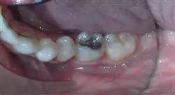 estudiar retratamiento del diente endodonciado