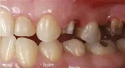 experto retratamiento del diente endodonciado
