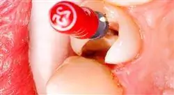 cursos endodoncia quirúrgica