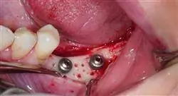 especializacion endodoncia quirúrgica