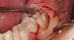 diplomado cirugía oral