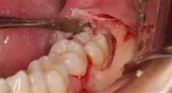 diplomado cirugía oral