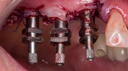 diplomado online periodoncia aplicada implantologiia