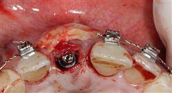 diplomado periodoncia aplicada a la implantología