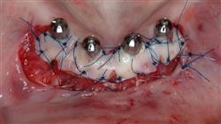 diplomado periodoncia aplicada implantologiia