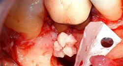 curso cirugía y microcirugía en endodoncia