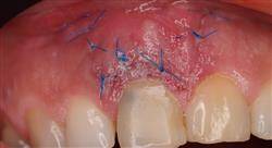 diplomado cirugía y microcirugía en endodoncia