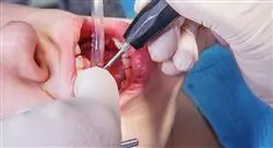 diplomado online patología pulpo periodontal y las relaciones endoperiodontales