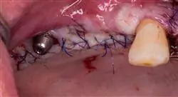 diplomado patología pulpo periodontal y las relaciones endoperiodontales