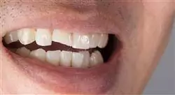 curso online traumatología dentaria en endodoncia
