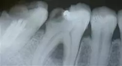 diplomado traumatología dentaria en endodoncia