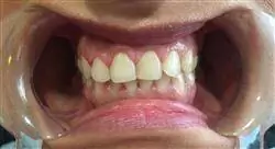 curso online patología y terapéutica de la pulpa dental en odontopediatría