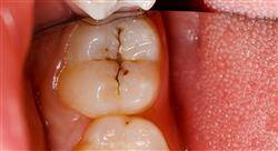 diplomado odontología pediátrica preventiva y caries dental