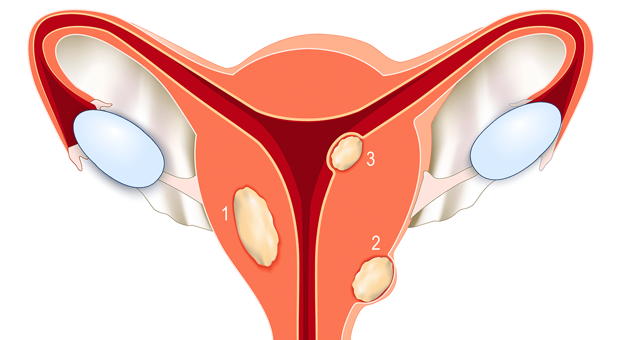 Субмукозная миома. Субмукозные миомы матки. Субмукозная (подслизистая) миома. Миома матки субмукозная форма что это.