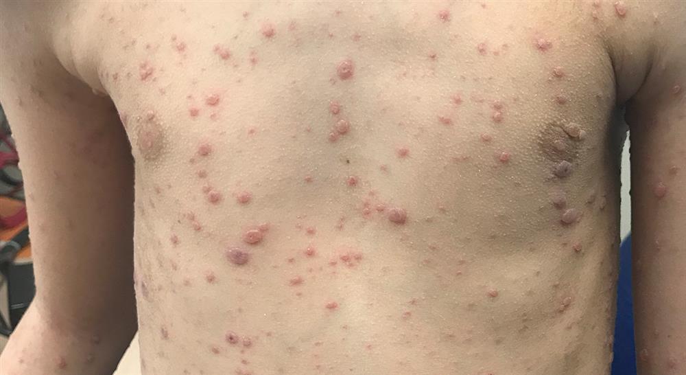 diplomado diagnostico microbiologico clinico enfermedades