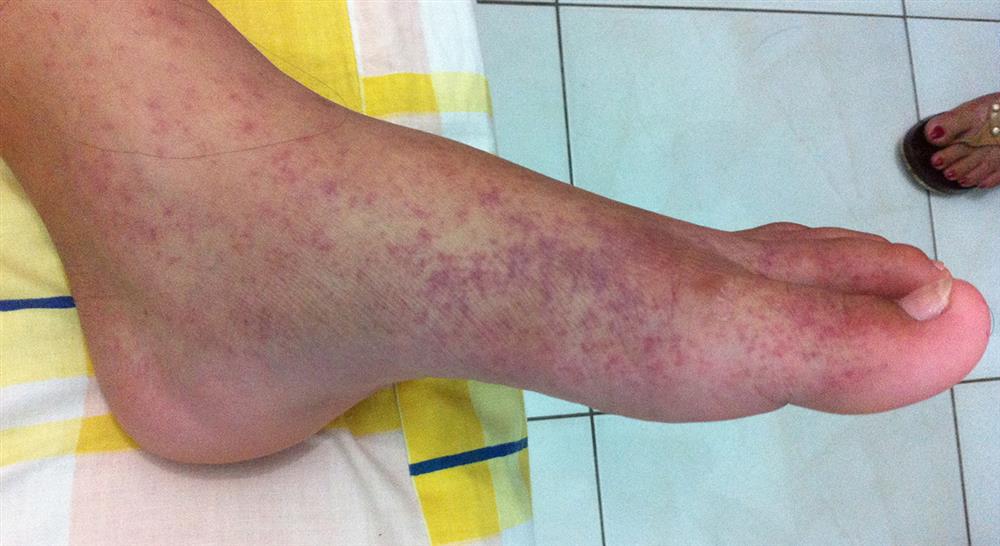 curso diagnostico tratamiento infeccion causada virus