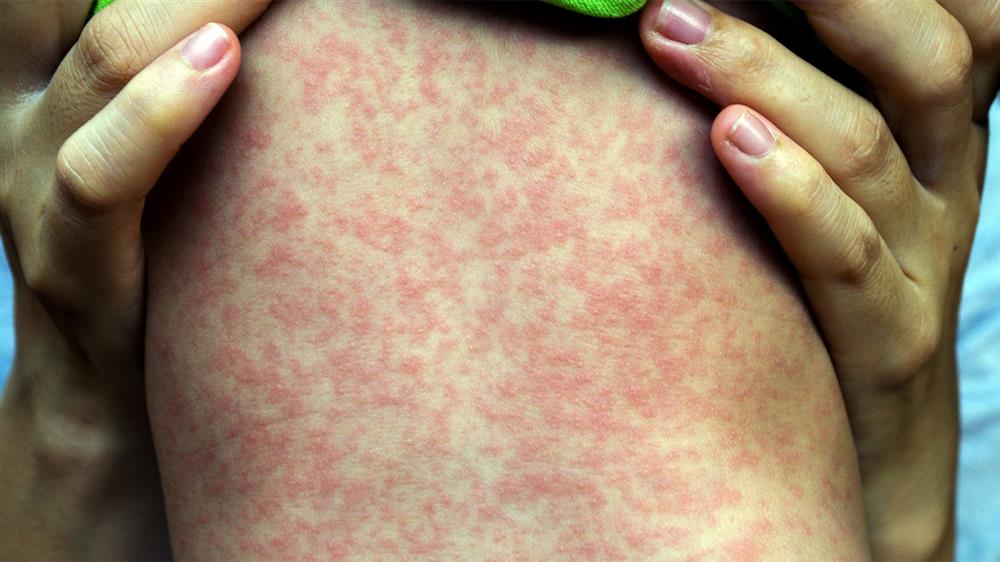 curso online diagnostico tratamiento infeccion causada virus