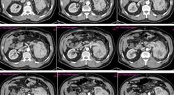diplomado cuidados paliativos en el enfermo renal crónico
