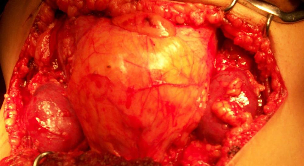 formacion trasplante renal para enfermería