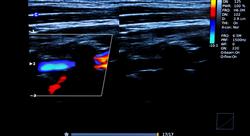 experto universitario ecografía torácica y vascular para enfermería