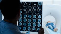 curso enfermedades cerebrovasculares enfermeria